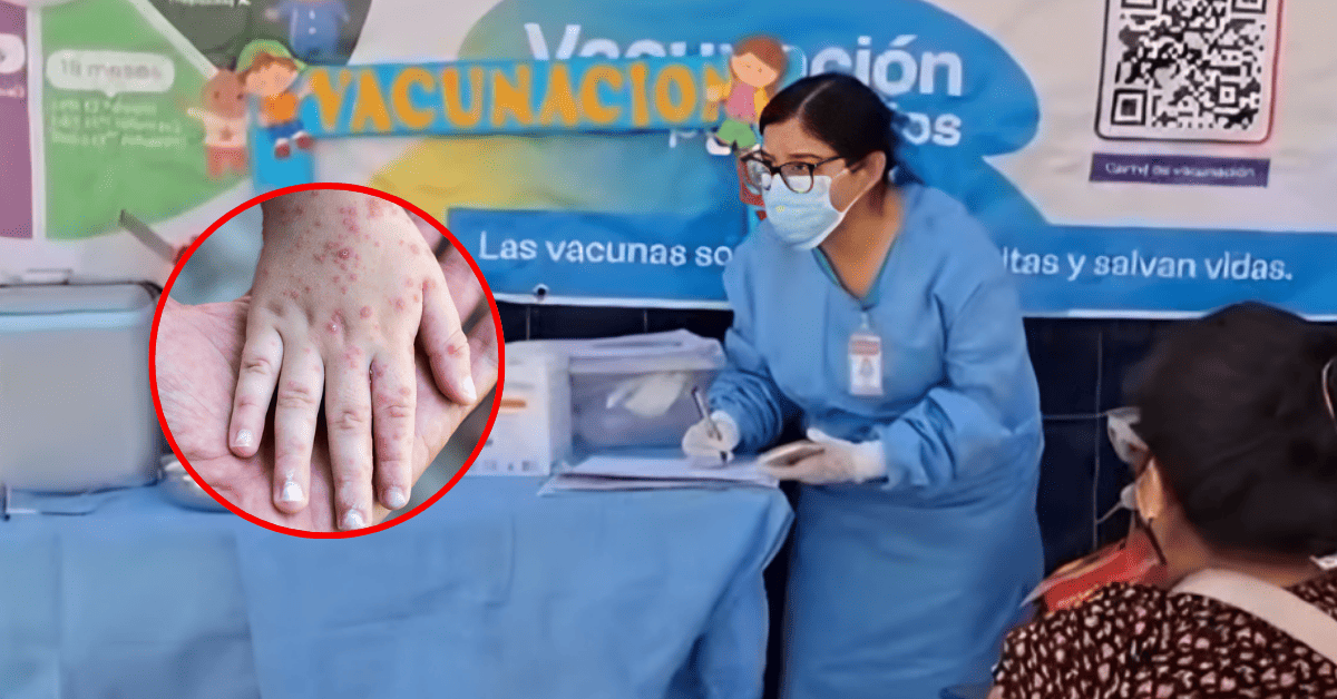 Confirman tercer caso de sarampión en Lambayeque y refuerzan cerco epidemiológico: Se trata de un niño de 5 años