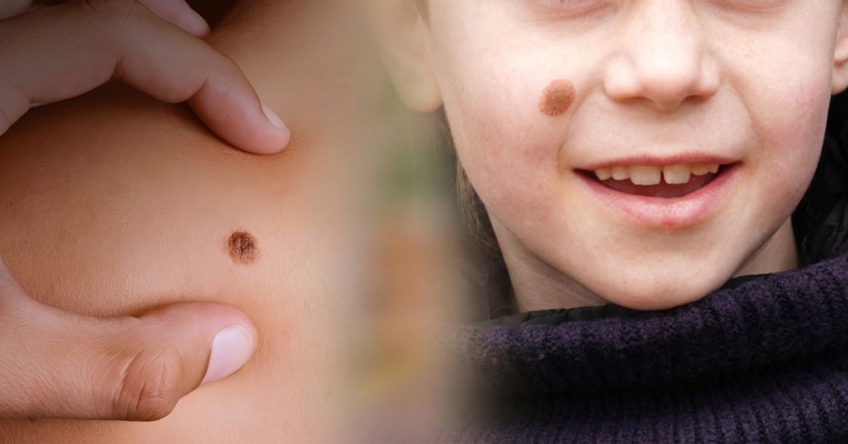 El INSN detecta entre 4 y 5 casos de cáncer de piel en niños cada año: Detecta las señales a tiempo